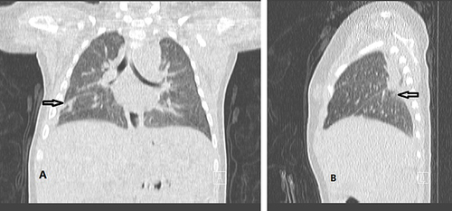 Figure 3 (A) Chest-CT after 8 weeks, the black arrow shows resolution, with minimal residual inflammatory zones. (B) Chest-CT after 8 weeks, the black arrow shows resolution, with minimal residual inflammatory zones.