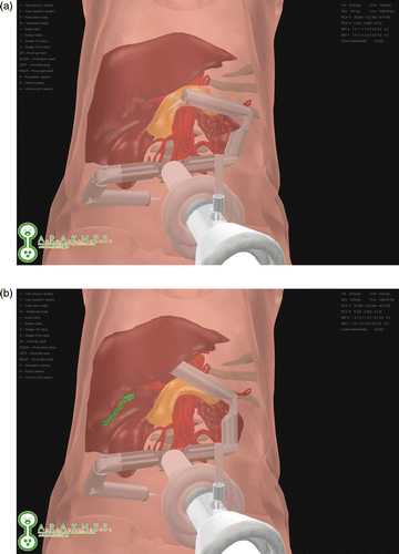 Figure 7. Interactions with the liver to expose the gallbladder during the simulation of a cholecystectomy. (a) The non-deformed anatomy. (b) The deformed liver.