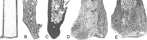 Figure 1 Histotopograms of peroneal stump ends (haematoxylin and eosin staining. x2.5): (A) Cylindrical shape with formation of bone closure plate from mature bone tissue; (B) Cone-shaped with congestion of the medullary canal (a) and a small periosteal regenerate (b); (C) Cone-shaped with occlusion of the medullary canal (a), violation of the integrity of the cortical diaphyseal layer (arrow); (D) Club-shaped with full length occlusion of the medullary canal with dense fibrous tissue (a), endosteal-periosteal regenerate at the end (b); (E) Club-shaped: resorption of the cortical diaphyseal plate and its replacement by endosteal-periosteal regenerate (a); endosteal bone beams (b); spongy cortical diaphyseal plate in the proximal region (c); fibrous cartilaginous tissue edging the end of the stump (d).