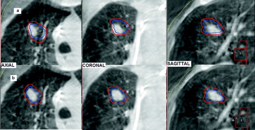 Figure 2.  Tumor alignment performed by CBCT, the ITV (in blue) and the PTV (in red) contours appear superimposed on the CBCT image: (a) visual check of the CBCT tumor position respect to the ITV contour, (b) the ITV contour was manually shifted to enclose the tumor image on CBCT.