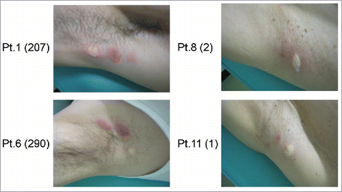 Figure 2. Skin reactions at the injection site in patients after third vaccination. The numbers within the parentheses represent the maximum spot number of GPC3-specific CTLs after vaccination. The 2 patients on the left exhibited stronger injection site reactions relative to those shown on the right.