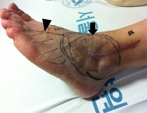 Figure 1 Allodynia (arrow, circle area) of scar tissue area and hypoesthesia (arrow head, oblique line area) on the dorsolateral side of the foot.