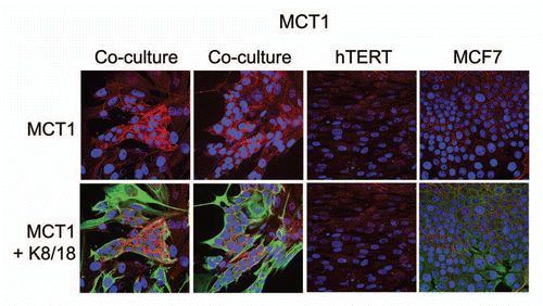 Figure 3 Fibroblasts induce the expression of MCT1 in MCF7 cancer cells. MCF7 cells were co-cultured with fibroblasts and then we observed the distribution of MCT1 (red) by fluorescence microscopy. Cultures of MCF7 cells alone or fibrobasts alone (monotypic cultures) were also processed in parallel. Note that MCT1 is not well expressed in MCF7 cells or fibroblasts, when cultured individually. However, under conditions of co-culture, MCT1 is specifically induced in MCF7 cells. Epithelial cancer cells were visualized by keratin staining (green).