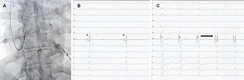 Figure 1 (A) Posteroanterior fluoroscopy image showing the final placement of a pacing lead in the right atrial appendage and a pacing lead at the level of the His bundle; (B) intraprocedural tracing during a 2:1 suprahisian AV block revealing the His bundle electrogram (*); (C) intraprocedural electrograms during His bundle capture threshold testing demonstrating the transition (marked by the black arrow), between non-selective and selective His bundle pacing.