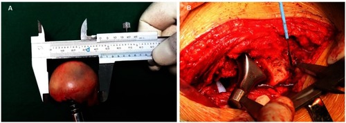 Figure 2 (A) The femoral head (d) was measured by a vernier caliper. (B) The distance should be obtained from the center of the femoral head prosthesis to the lesser trochanter during operation.