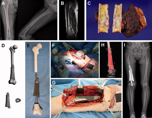 Figure 2. Femoral reconstruction. Images of patient #8. (A) Preoperative plain radiographs and (B) a T2-weighted MR image showing undifferentiated pleomorphic sarcoma of the bone arising from the distal femoral shaft. (C) Resected bone tumor as planned. (D) Graphical designs of the 3D-printed implant and (E) photograph of the 3D-printed implant and intramedullary nail to be used. (F) Intraoperative photograph showing cement injection through a premade hole. (G) Intraoperative photograph, (H) postoperative CT reconstruction image, and (I) teleradiogram showing femoral reconstruction.