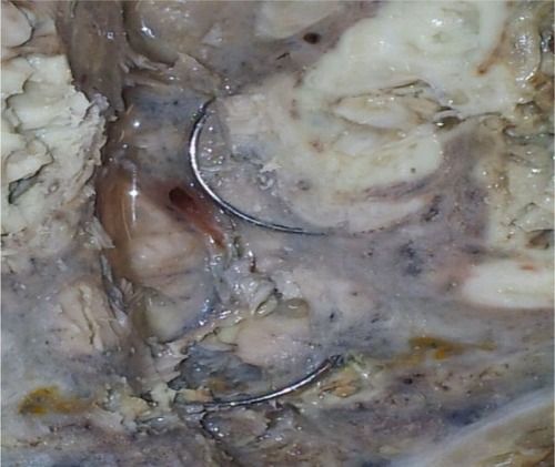 Figure 6 Lung autopsy after coil implantation.