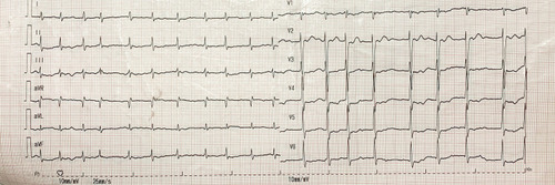 Figure 1 Electrocardiogram at admission. Atrial fibrillation, mild ST segment depression in leads V 3–6.T wave inversion.