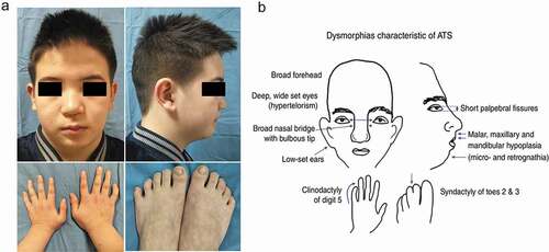 Figure 2. Skeletal-craniofacial features of the patient 5 with Andersen-Tawil Syndrome. (a) Widely spaced eyes, small mandible, low-set ears, and fifth-digit clinodactyly. (b) Dysmorphias characteristic of ATS, which can be found in Adams DS et al.(2016). DOI: 10.1113/JP271930