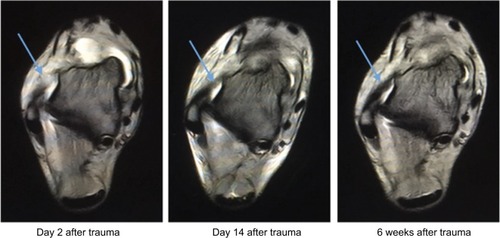 Figure 4 Ankle sprain with rupture of the anterior talofibular ligament.