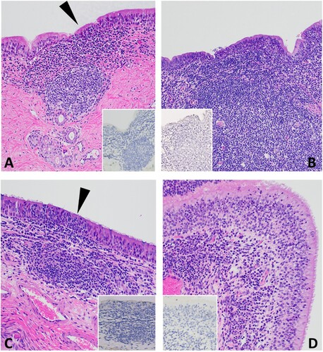 Figure 5. Histopathology of 3 DPC respiratory tissues from calf HT1. At 3 DPC, (A) in the trachea, there was mild and segmental attenuation of the respiratory epithelium with loss of cilia, lymphocyte and/or neutrophil transmigration through the epithelium, individual cellular degeneration and necrosis, and occasional accumulation of cellular debris on the epithelial surface (arrowhead). Dense sheets of mononuclear inflammatory cells expanded into the lamina propria and commonly follicular aggregates of lymphocytes, plasma cells and macrophages arranged into loose aggregates or partially organized follicular structures; SARS-CoV-2 antigen was not detected by IHC (insert). (B) Similar segmental attenuation of the respiratory epithelium was noted in the bronchi with cellular degeneration/necrosis of individual epithelial cells, lymphocytic and neutrophilic transmigration. Loose infiltrates of lymphocytes and a lesser number of neutrophils were observed in the superficial mucosa and mixed lymphocytic and histiocytic infiltrates, many arranged in follicular aggregates expanding into the superficial and deep lamina propria; SARS-CoV-2 viral antigen was not detected (insert). (C) The rostral turbinates were characterized by lymphoplasmacytic or neutrophilic rhinitis with epithelial transmigration of inflammatory cells (arrowhead) and segmental loss of cilia. Mixed lymphocytic and histiocytic inflammation multifocally expanded the subjacent lamina propria and the interstitium separating submucosal glands. IHC for SARS-CoV-2 viral antigen was negative (insert). (D) The olfactory mucosa contained similar lymphoplasmacytic or histiocytic inflammation within the lamina propria and the interstitum separating submucosal glands; SARS-CoV-2 viral antigen was not detected (insert). H&E and Fast Red, 40× total magnification.