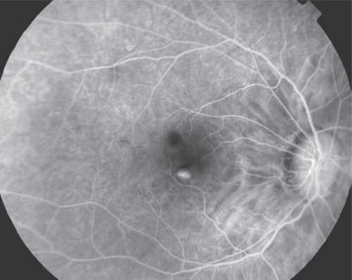 Figure 1 Fluorescein angiography demonstrated small inferior juxta-foveal choroidal neovascularization OD.