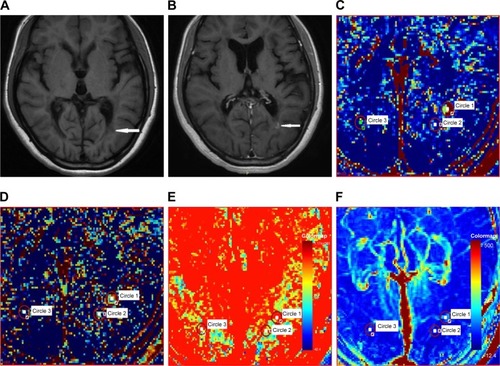 Figure 2 The representative images of dynamic contrast-enhanced magnetic resonance imaging with Patlak model.