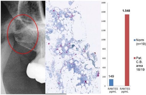 Figure 8 Left panel: 2D X-ray of area 18/19. Middle panel: Immunohistochemistry without signs of R/C overexpression. Right panel: atypical R/C expression (Multiplex) of 1.548 pg/mL (norm =155.9 pg/mL).