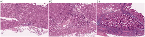 Figure 2. The bile duct wall was injured thermally and the epithelium was sloughed off as a result of the treatment (a). Eosinophilic coagulative necrosis was observed at the bile duct wall and the surrounding tissue (b, c).