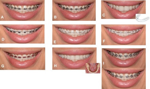 Figure 1 The different orthodontic appliances displayed in the questionnaire.