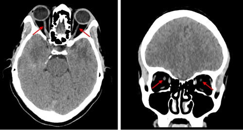 Figure 1. Axial and coronal reconstruction of non-contrast CT head showing the right optic nerve sheath diameter greater than left (red arrows).