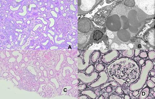 Figure 1 Kidney biopsy findings. (A) the glomerular compartment is unremarkable: normal capillary wall and no mesangial or endocapillary hypercellularity, renal cortex with inflammation ((A) periodic acid-Schiff stain, original magnification, 200x; (B) electron microscopy exhibiting podocyte focal foot process effacement without changes to the glomerular basement membrane; (C) renal cortex exhibiting mild interstitial edema and inflammation as well as acute tubular injury. (H&E stain, original magnification, 100x); (D) normal capillary walls without mesangial or endocapillary hypercellularity (Jones methenamine silver stain, original magnification, 200x).