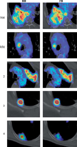 Figure 1. Fused transaxial PET/CT images of patients 1–4, with patient 1 presenting two lesions (a and b). The display range of SUV values was manually adjusted for each patient. Images obtained following breath hold (BH, left) and free breathing (FB, right) are shown.