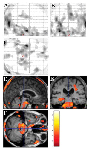 FIGURE 2. Inter-CJD SPM analysis, using a stringent level of significance of p<0.001 and an extent threshold of 100 voxels, in patients with cerebellar ataxia, showing FDG-PET hypometabolism in the pons, the bilateral (left-predominant) middle cerebellar peduncles, the right frontal subcortical lobe, and the left mesial temporal cortex.
