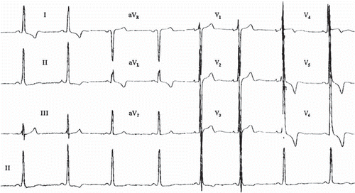 Figure 1. The ECG in hypertrophic cardiomyopathy. High QRS voltage in the absence of hypertension with repolarization changes (strain pattern) in the ST segments of inferior and lateral leads, and inversion of terminal P wave in lead V1. Notching of the QRS up-stroke in inferior leads, giving a delta wave-like appearance, is also detected. Paper speed 25 mm/s, gain 10 mm/mV.