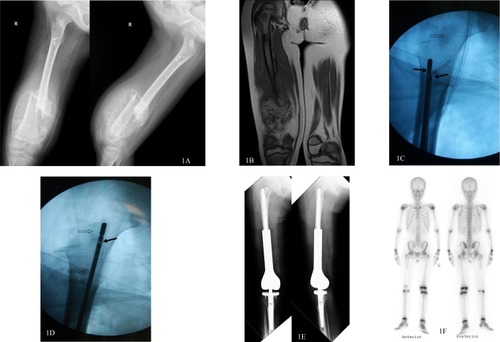 Figure 1 A nine-year old girl with osteosarcoma in the right distal femur got a very good response for preoperative chemotherapy. Skip metastases in proximal femur and intertrochanteric area were clearly shown in plain radiographs (A) and MR imaging (B) after preoperative chemo. A microwave antenna and a thermocouple (solid arrows) were inserted into the remaining intramedullary canal of the femur and the ablation of skip metastases (hollow arrows) were performed with fluoroscopic guidance (C, D). After the ablation, the bone defect was reconstructed with distal femoral endoprosthesis and hip function was retained (E). No local recurrence of skip metastasis was found in Tc-99m bone scan 36 months after the operation (F).