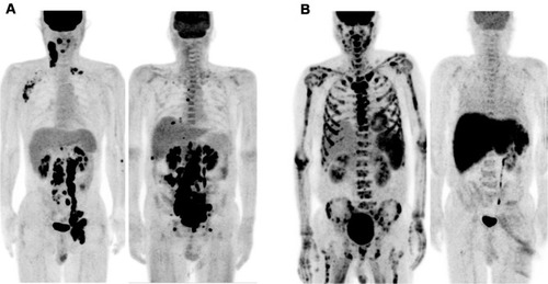 Figure 1 Maximum intensity projection (MIP) FDG PET/CT images of representative IVLBCL patients of the Nodal and EN/DS5 groups. (A) A 59-year-old patient (left) and a 52-year-old patient (right) with hypermetabolic LN involvement. (B) A 69-year-old patient with high-uptake involvement of the bone marrow and spleen (left) and a 70-year-old patient with high-uptake involvement of the liver and spleen (right).