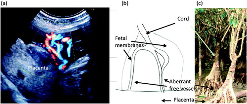 Figure 1. Velamentous insertion of the umbilical cord, its color Doppler image (a), schematic presentation of aberrant vessels of Bręborowicz et al.’s Figure 1C [Citation1] (b) and a mangrove tree (c). (a) Color Doppler image of velamentous cord insertion, which was obtained from a 30-week ultrasound scan of a pregnant woman: who was later confirmed to have velamentous cord insertion and gave abdominal birth to an infant. The arrow indicates aberrant vessels running over the fetal membranes to the placental surface. (b) The figure of the cord and placenta of Bręborowicz et al.’s case (their Figure 1C [Citation1]) mimics the color Doppler image of Figure 1(a). (c) A mangrove tree: the trunk represents the cord. The trunk branches into several roots, reaching the ground, which indicates the cord, aberrant vessels, and placental surface. The ultrasound image shown in Figure 1(a) resembles a mangrove tree, and thus we named this sign a “mangrove sign” [Citation2].