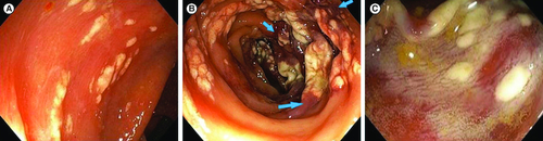 Figure 1. Endoscopic aspects.(A) Slightly elevated whitish–yellow plaques. (B) Confluent plaques creating a pseudomembranous aspect, sometimes surrounded by erythematous colonic mucosa (blue arrows). (C) Formation of plaques rapidly after the appearance of whitish foamy fluid.