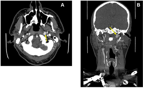 Figure 2 Focal dilatation of left internal carotid artery. (A and B) Axial (A) and coronal reformatted (B) postcontrast CT images show a left extracranial internal carotid artery dilatation (yellow arrows).