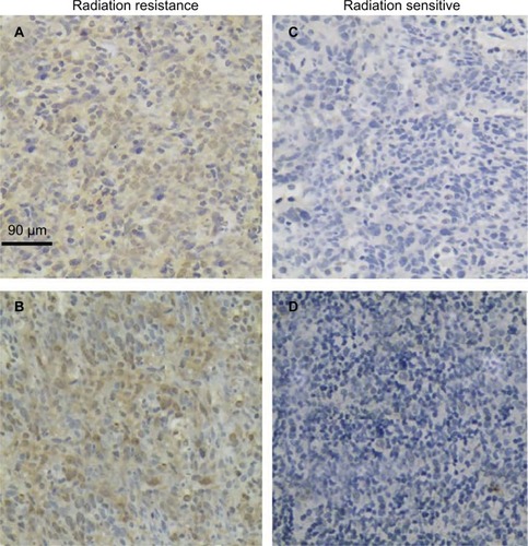 Figure 1 Expression of MAP2K6 in radiation-resistant (upper) and radiation sensitive (lower) NPC tissues – radiation resistant: (A) 60% and (B) 0%; radiation sensitive: (C) 5% and (D) 10%.Abbreviation: NPC, nasopharyngeal carcinoma.