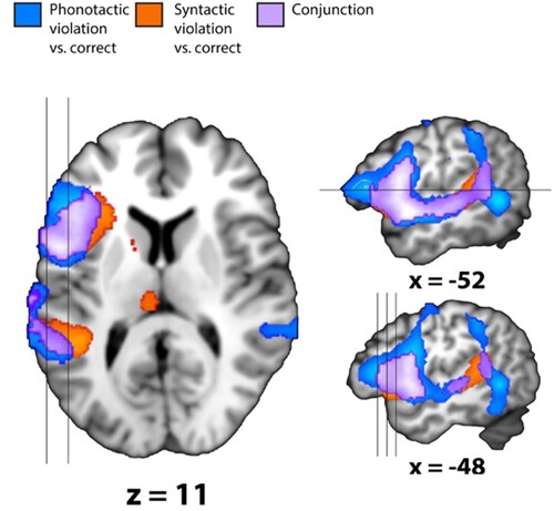 Figure 2. Whole brain results. The figure shows the two main contrasts: phonological violation vs. correct (in blue) and syntactic violation vs. correct (in orange). In purple, we display the conjunction of these two contrasts. All clusters in the images are significant at corrected PFWE < 0.05. To the left, we display an axial plane (z = 11), indicated by a line crossing the upper sagittal plane, one step to the right. The locations of the two sagittal planes are depicted by two lines crossing the axial plane. In the lower sagittal plane, the locations of the three coronal planes in Figure 3 are indicated. All brain figures were drawn using the mango software (http://ric.uthscsa.edu/mango/mango.html).