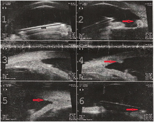 Figure 2. Ultrasound biomicroscopy with nodules over the iris, intraocular lens, and posterior face of corneal incisions.