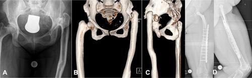 Figure 6 High hip developmental dislocation (Crowe IV) (A). An Ilizarov leg lengthening procedure was performed years ago with the result of a massive curvature of the diaphysis (B and C). Metha® short stem was established after a diaphyseal shortening and derotation osteotomy which was secured by an angle locking plate (D).