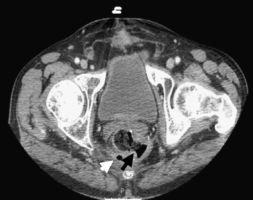 Figure 1.  An abdominal computerized tomography of patient 1 was conducted after the third course of bevacizumab and FOLFIRI. The black arrow indicates a fistula originating from the left posterolateral wall of the rectum. Air bubbles in the perirectal area (white arrow) are suggestive of a perirectal abscess.