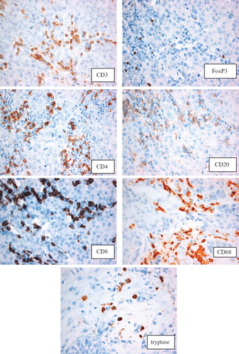 Figure 1. Immunohistochemical stainings. Membraneous stainings of CD3, CD4, CD8 and FoxP3 (nuclear staining) all markers of different subgroups of T-cells. Membraneous staining of CD20 (B-cells). Cytoplasmic stainings of CD68 (macrophages) and tryptase (mast cells).