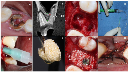 Figure 2 MIAMBE (Minimally Invasive Antral Membrane Balloon Elevation) - Control group. (A) Periodontally and endodontically compromised tooth. (B) CBCT showing deficient native bone. (C) Atraumatic extraction showing the intact interradicular bone. (D) Minimally Invasive Antral Balloon with Inflated saline solution. (E) MIAMBE Technique for transcrestal sinus floor elevation. (F) Autologous fibrin integrated ẞ-TCP (Sticky bone) for sinus augmentation. (G) Immediate implant placement and jumping distance between the socket and the implant, as well as the adjoining sockets was also grafted with the fibrin integrated ẞ-TCP (Sticky bone). (H) A-PRF was laid over with flap approximation and sutured.