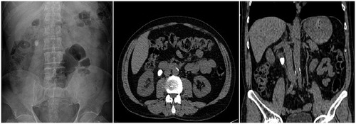 Figure 1. Impacted upper ureteral calculi images.