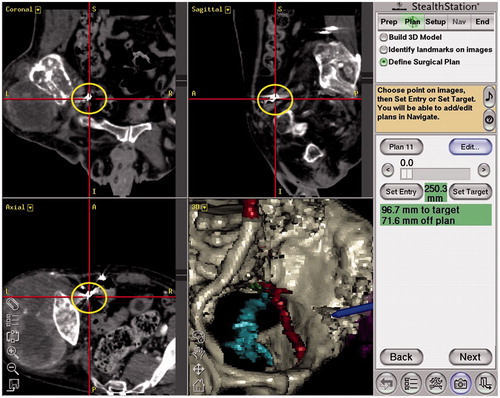 Figure 1. Intraoperative navigation view of Case 4. The embolization coil is a bright point at the intersection of the red lines, indicated by the yellow circle. It was easily palpable and helpful as a reference point.