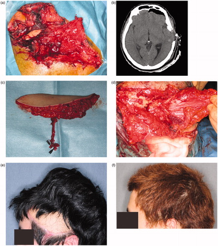 Figure 2. (a) The patient had a large defect (including the soft tissue, scalp, and dura) in the left temporal region. The wound was contaminated with sand, pieces of metal, and machine lubricant. (b) CT findings suggest that the depth of the wound reached the brain tissue. (c) A 15 × 8 cm anterolateral thigh flap with 8 × 8 cm of fascia was harvested. (d) Vascularized fascia was fixed to the edge of the dura. (e) A 70 × 120-cm tissue expander was inserted under the scalp. Preoperatively, 270 ml of expansion was achieved. (f) Two years after final surgery. The skin paddle made from the anterolateral thigh flap was completely removed.