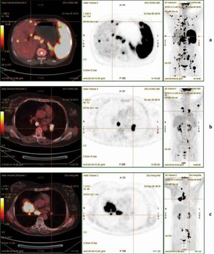 Figure 1. Whole-body PET/CT scan prior to treatment initiation (a). PET/CT imaging showed several enlarged or new lesions after six cycles of R-CHOP (b) and following CAR-T cell therapy (c)