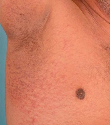 Figure 1 Coalescent hyperpigmented papules over the axilla with marked reticulation at the peripheries.