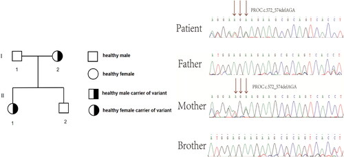 Figure 3. Genetic analysis of the PROC gene in the family. Sequencing of the PROC gene revealed that the patient carried the heterozygous deletion variant c.572_574delAGA of PROC. Family study showed that PROC c.572_574delAGA was inherited from the subject’s mother, while the subject’s brother did not inherit PROC c.572_574delAGA from his parents. The arrow indicates the mutation.