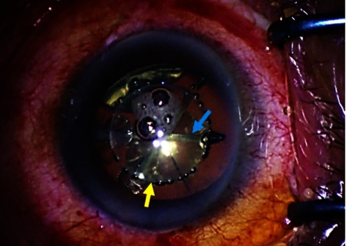 Figure 7 Intraoperative image in the left eye taken during femtosecond laser surgery showing a continuous curvilinear capsulorhexis, 5.0 mm in diameter, centered on White to White (yellow arrow). Nuclear fragmentation was successfully achieved using the chop mode (blue arrow).