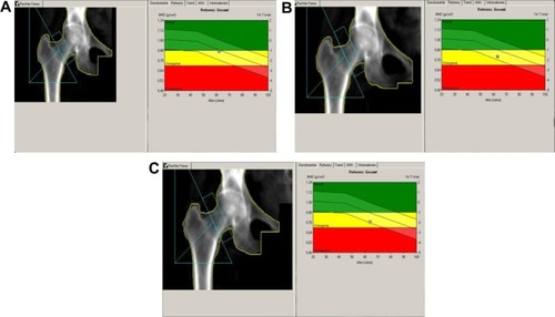 Figure 3 Right femur bone mass density over time. (A) At baseline, (B) at 12 months, and (C) at 24 months.