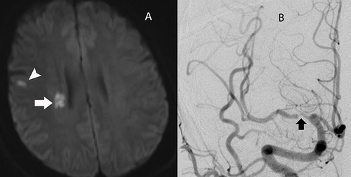 Figure 1 (A) Diffusion weighted image revealed acute ischemic infarction foci in right parietal lobe (white arrowhead) and para-lateral ventricle (white arrow). (B) DSA determined that the MCA M1 segment was the criminal artery with severe stenosis (black arrow).