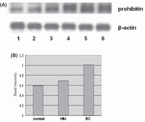 Figure 6. Correlation analysis of prohibitin expression with clinicalpathological characteristics. (A and B) The expression of prohibitin was increased from normal breast (lane 1–2), hyperplastic mammary (HM) (lane 3), to breast carcinoma (BC) lanes 4–6). However, prohibitin expression was not correlated with the differentiation status of breast carcinoma (lanes 4–6 are low-, medium-, and high-differentiated breast carcinoma, respectively).