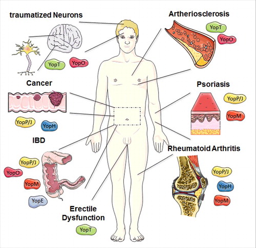 Figure 2. Overview of potential therapeutic uses of Yops. The most promising therapeutic application of YopM is the treatment of the auto-inflammatory diseases such as psoriasis, rheumatoid arthritis (RA), and inflammatory bowel diseases (IBD). Based on the molecular mechanism described before, potential areas of medical application for a recombinant, cell-penetrating YopE protein are IBD. YopT and especially its downstream target Rho-associated protein kinase ROCK are involved in several disease patterns, often within the cardiovascular field e.g., arteriosclerosis but also erectile dysfunction and traumatized neurons might be a target for a cell-penetrating YopT. A cell-penetrating effector YopO might be beneficial for the treatment of diseases associated with hyperactivated Rho-GTPases similar to YopE and YopT, but also for targeting mediators of auto-immune diseases like inflammatory bowel diseases. YopJ and its impact on signaling cascade displays potential therapeutic potential for inflammatory disorders, such as Psoriasis, RA, and IBD, but also for cancer control. RA also appears to be a promising area of application for recombinant YopH. Moreover, cancer progression also relies on signaling pathways tackled by the effector protein. The figure was produced using Servier Medical Art.