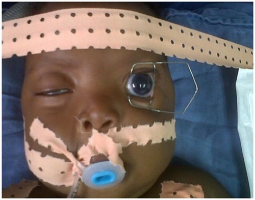 Figure 1 Buphthalmos and megalocornea in congenital glaucoma (photo, André Omgbwa Eballé, Cameroon).