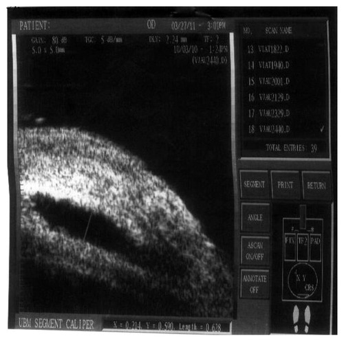 Figure 10 The measurement of the bleb height.